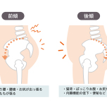 骨盤の歪みのイメージ