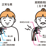 五十肩