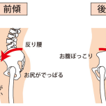 骨盤の歪み