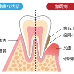 歯周病