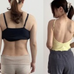 背中のビフォーアフター