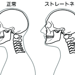 ストレートネック