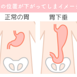胃下垂のイメージ
