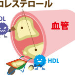動脈硬化イラスト