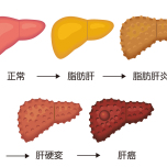 肝臓正常から癌まで
