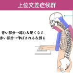 上位交差症候群