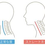 ストレートネック
