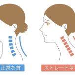 ストレートネック