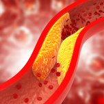 動脈硬化