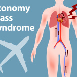 エコノミー症候群