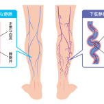 下肢静脈瘤