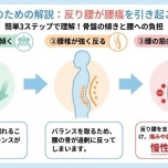 腰痛メカニズム