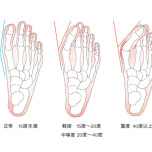 外反母趾