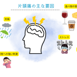 片頭痛の要因