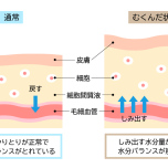 むくみ