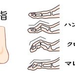 足指の変形