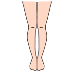 膝下O脚　XO脚　イラスト