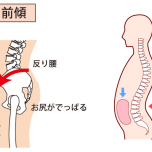 反り腰