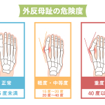 外反母趾