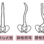 側湾症イメージ