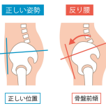 反り腰